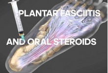 How to cure Plantar fasciitis with steroids